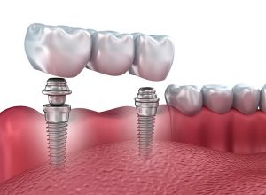 manchester dental implants